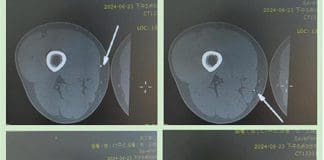 Attempt to Remove Bearing Metal Shards with Magnet Ends in Failure